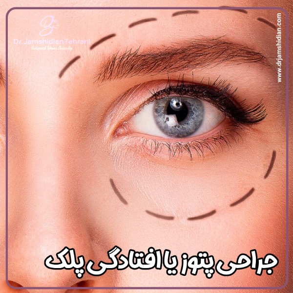 جراحی پتوز - دکتر منصوره جمشیدیان