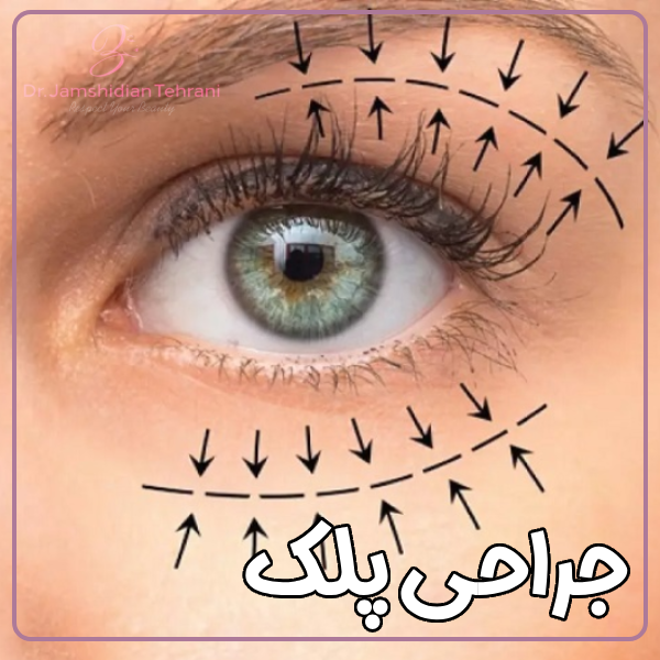 جراحی پلک - دکتر منصوره جمشیدیان طهرانی
