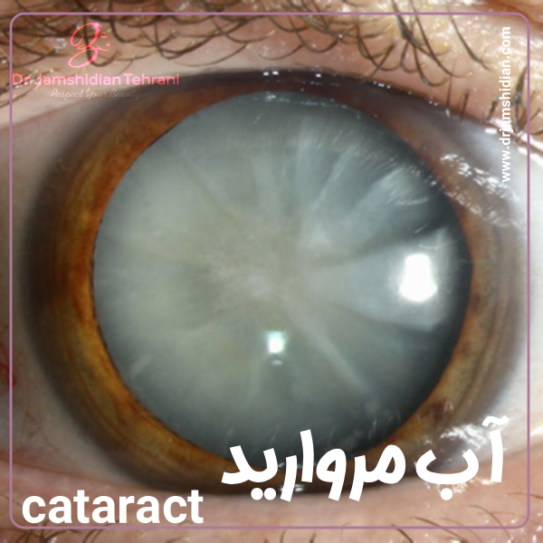 آب مروارید - دکتر منصوره جمشیدیان طهرانی