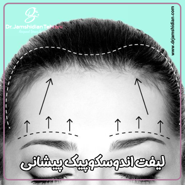 لیفت اندوسکوپیک پیشانی - دکتر منصوره جمشیدیان طهرانی