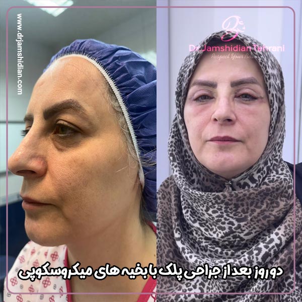 جراحی پلک - دکتر جمشیدیان