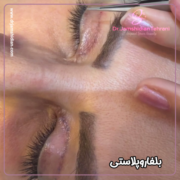 جراحی پلک - دکتر جمشیدیان