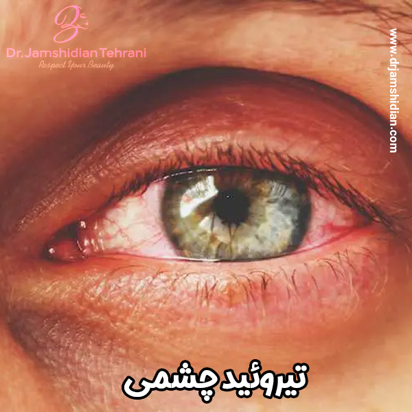 تیروئید چشمی - دکتر منصوره جمشیدیان طهرانی