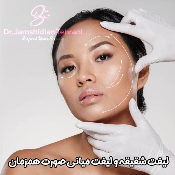 لیفت شقیقه و لیفت میانی صورت همزمان - دکتر منسوره جمشیدیان طهرانی