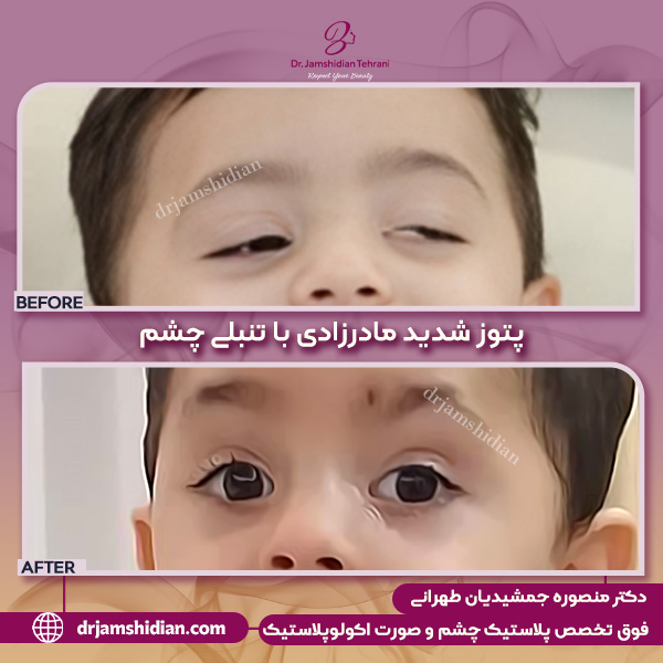 پتوز مادرزادی - دکتر منصوره جمشیدیان طهرانی