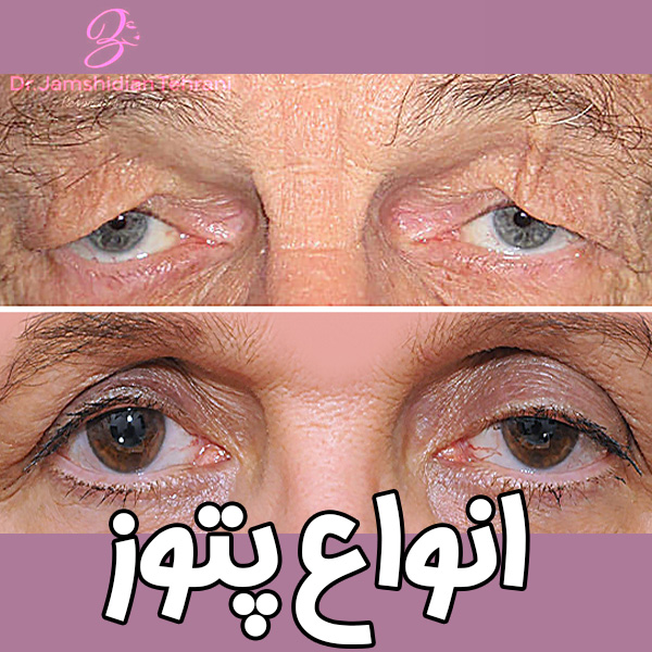 انواع پتوز - دکتر منصوره جمشیدیان طهرانی