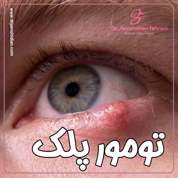 تومور پلک با دکتر منصوره جمشیدیان طهرانی