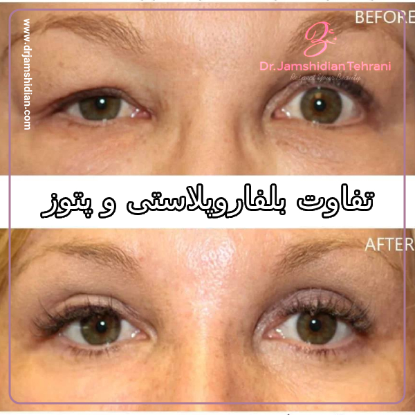 تفاوت بلفاروپلاستی و پتوز