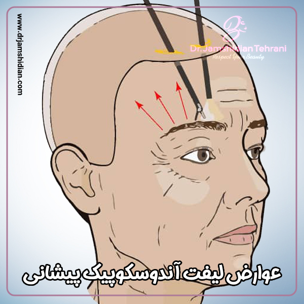 عوارض لیفت آندوسکوپیک پیشانی با دکتر منصوره جمشیدیان طهرانی