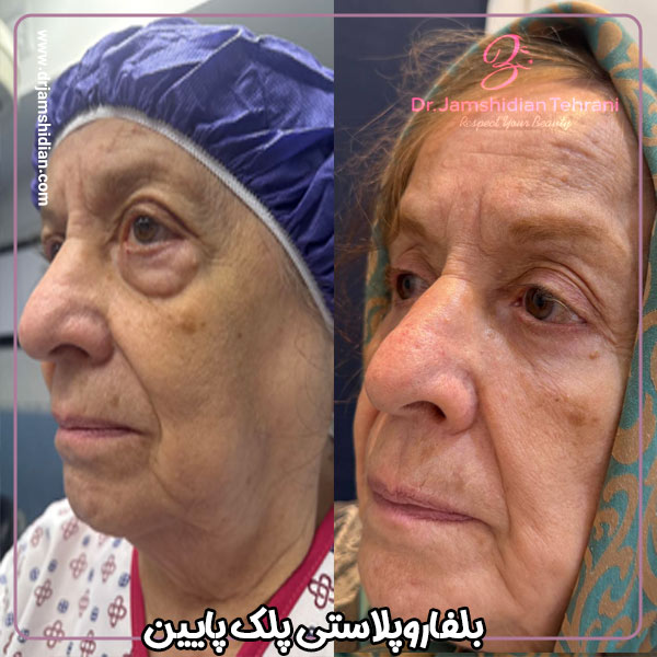 جراحی پلک پایین - دکتر منصوره جمشیدیان