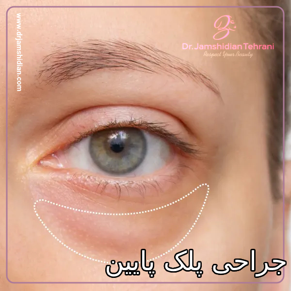 جراحی پلک پایین در تهران با دکتر جمشیدیان
