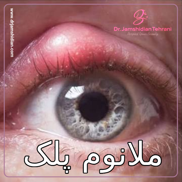 ملانوم پلاک - دکتر منصوره جمشیدیان طهرانی