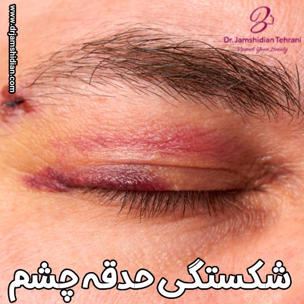 شکستگی حدقه چشم - دکتر منصوره جمشیدیان طهرانی