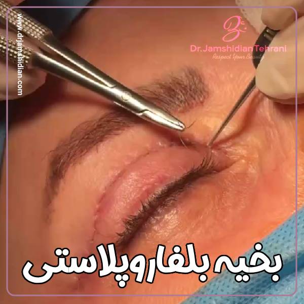 بهترین زمان برای کشیدن بخیه بلفاروپلاستی با دکتر منصوره جمشیدیان طهرانی