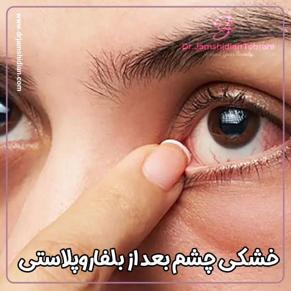 خشکی چشم بعد از بلفاروپلاستی با دکتر جمشیدیان در تهران