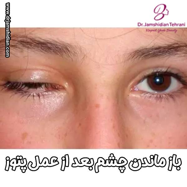 علت باز ماندن چشم بعد از عمل پتوز توسط دکتر جمشیدیان طهرانی