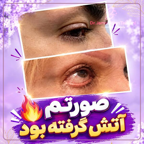 عوارض بلفاروپلاستی - دکتر جمشیدیان