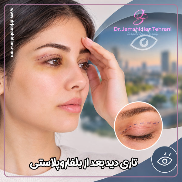 تاری دید بعد از بلفاروپلاستی - دکتر جمشیدیان