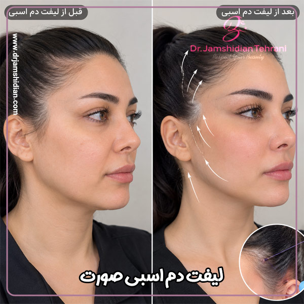 لیفت دم اسبی صورت - دکتر جمشیدیان